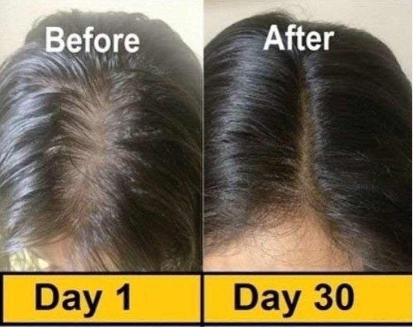 PRO HAIRVIT HAIR OIL | Intensive Anti-Dandruff Oil for Healthy Hair –  Millennium Herbal Care