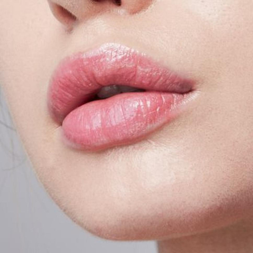 Cheilitis SimplexAngular CheilitisActinic