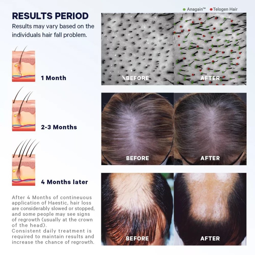 Steroid injections for hair loss  fact sheet and definitive guide