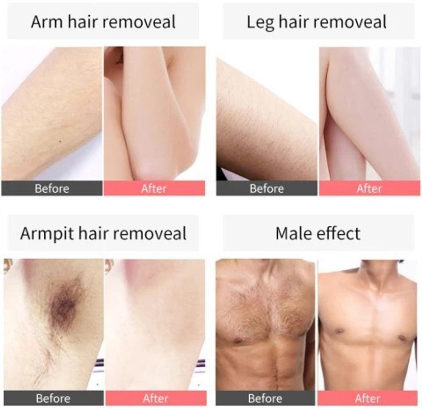 Discover more than 86 permanent upper lip hair removal in.eteachers