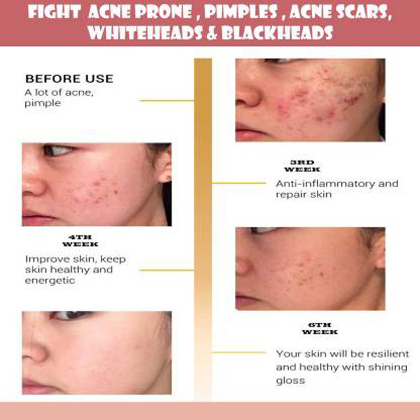 amueroz anti acne serum