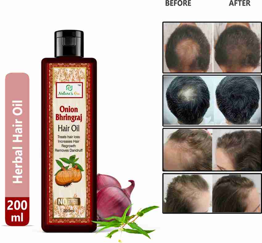 Nature's Era Onion Bhringral Hair Regrowth Herbal Oil|Controls Hair Loss &Dandruff |Men/Women Hair Oil - Price in India, Buy Nature's Era Onion Bhringral Hair Regrowth Herbal Oil|Controls Hair Loss &Dandruff |Men/Women Hair Nature's Era Onion Bhringral Hair Regrowth Herbal Oil|Controls Hair Loss &Dandruff |Men/Women Hair Oil - Price in India, Buy Nature's Era Onion Bhringral Hair Regrowth Herbal Oil|Controls Hair Loss &Dandruff |Men/Women Hair