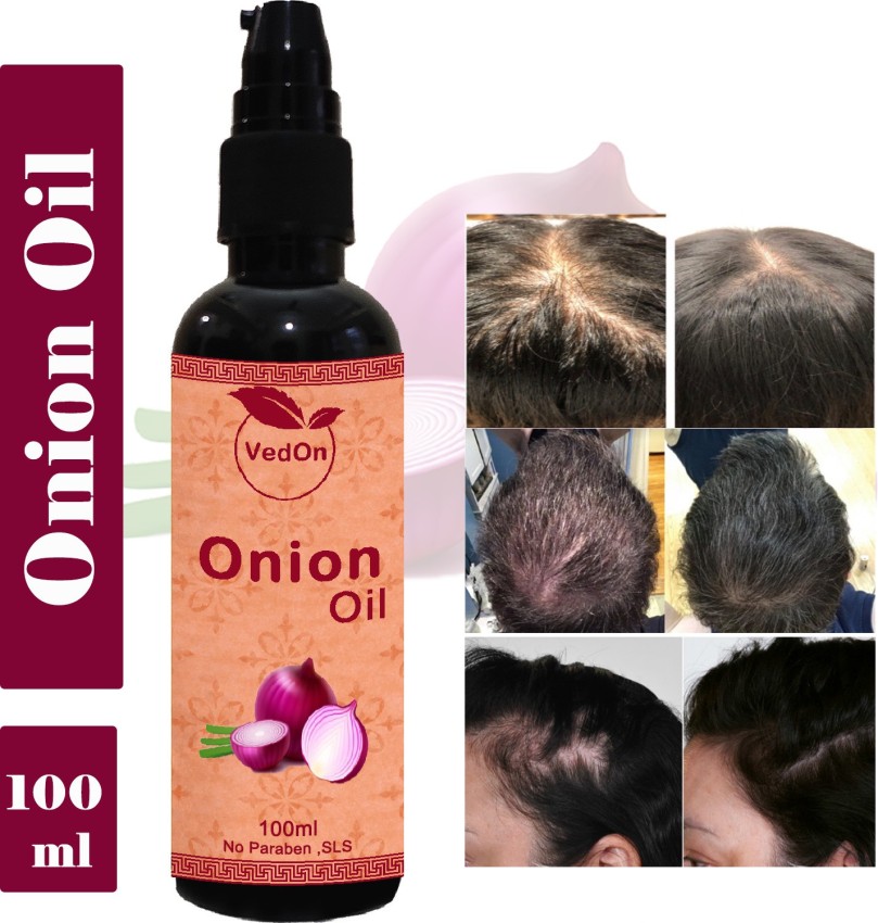 VedOn Onion black seed oil for Hair growth AND Reduce Hair fall Hair Oil -  Price in India, Buy VedOn Onion black seed oil for Hair growth AND Reduce  Hair fall Hair Oil Online In India, Reviews, Ratings & Features 