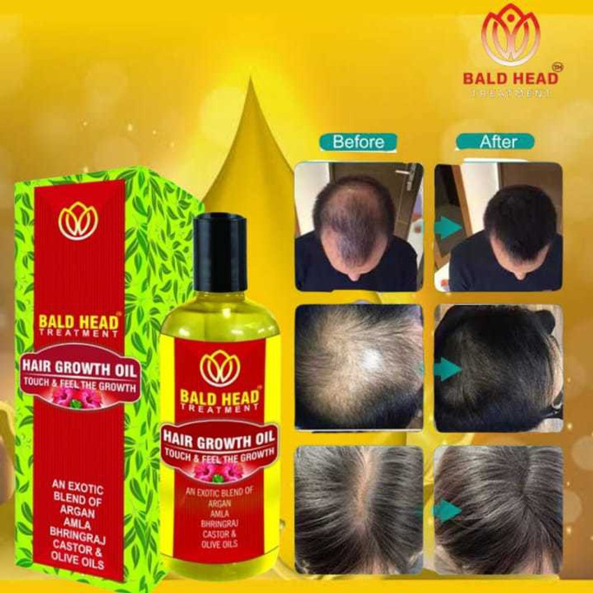 Details more than 76 bald hair growth oil best in.eteachers