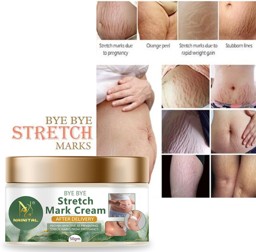 Stretch Mark treatments at Cheshire Lasers, Middlewich.